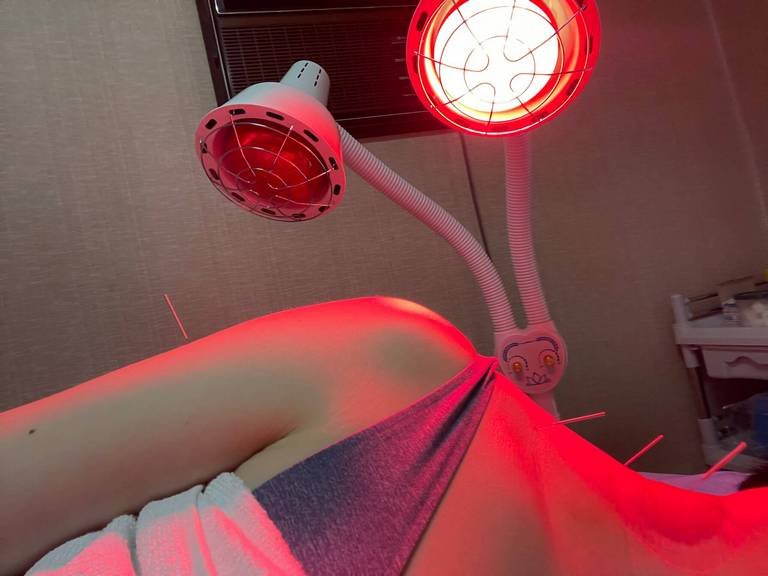 Functional dry needling